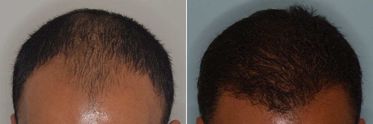 Hair Transplant before and after, frontal.