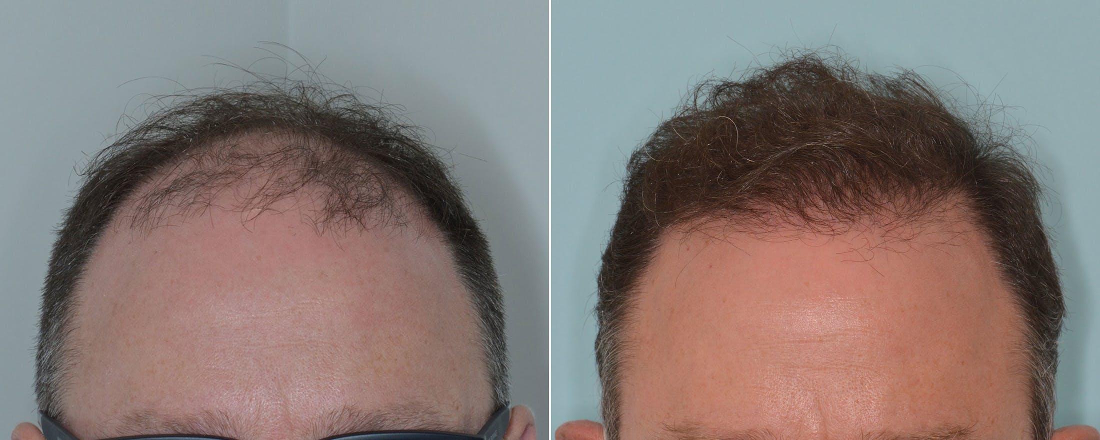 Hair Transplant before and after, frontal.