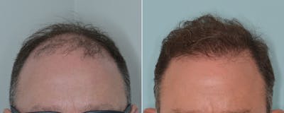 Hair Transplant before and after, frontal.