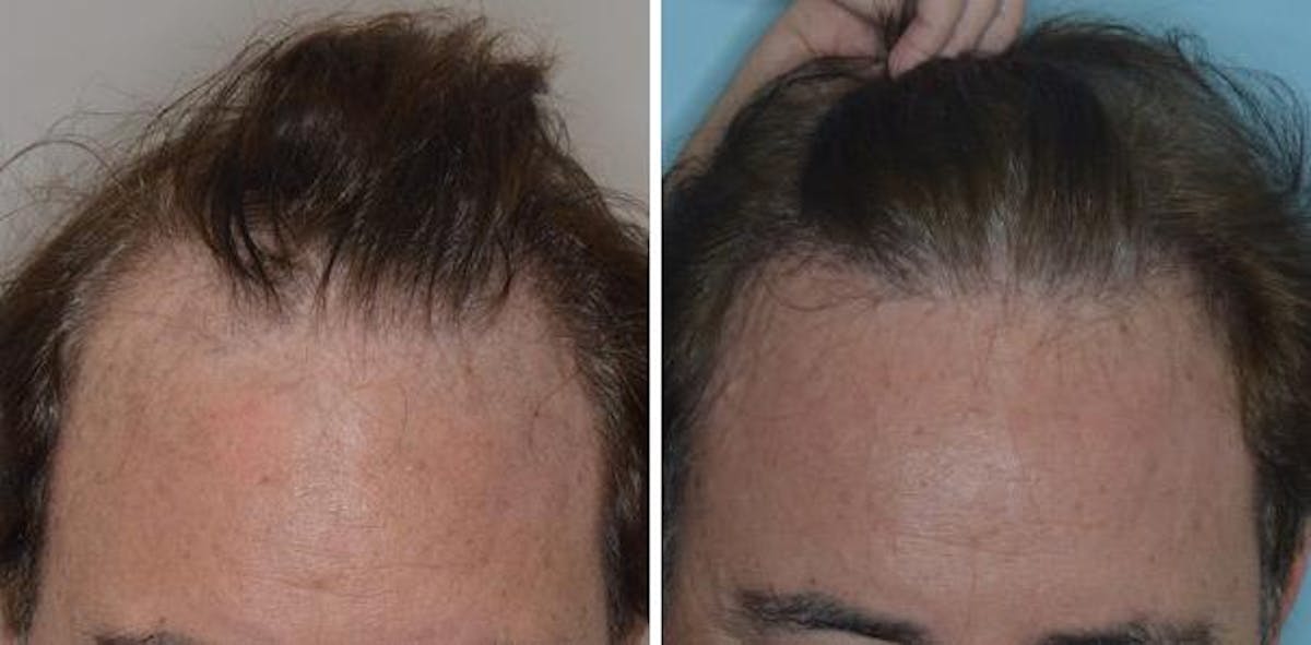 Hair Transplant before and after, frontal.