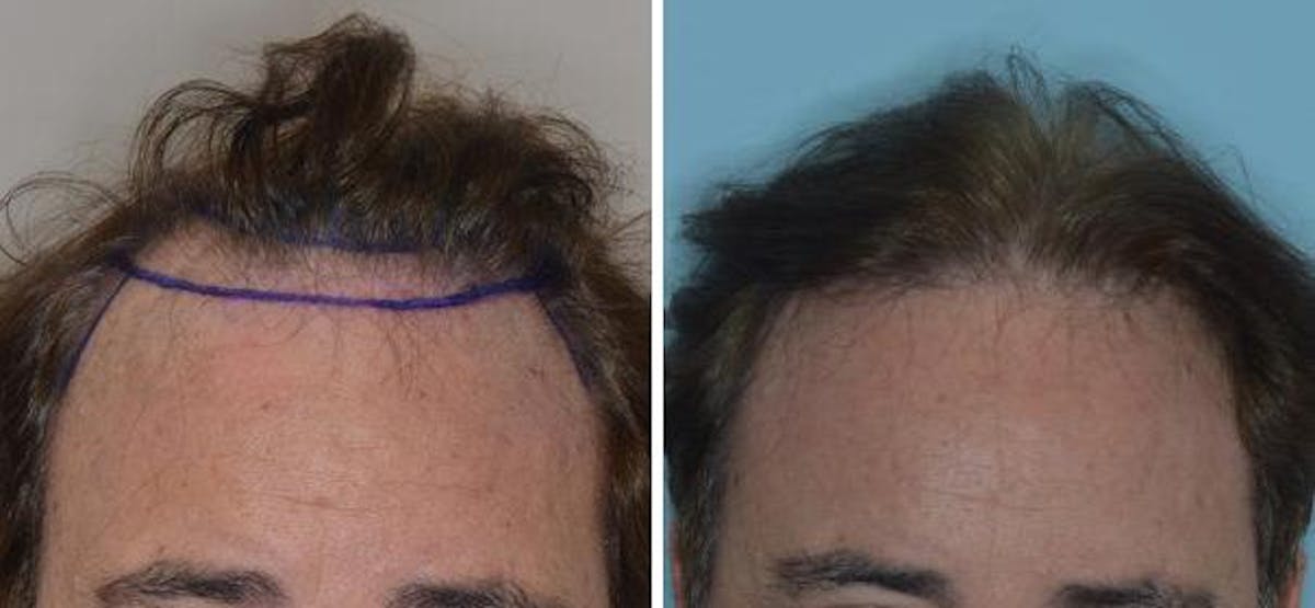 Hair Transplant before and after, marked.