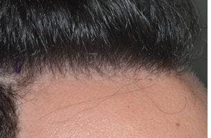 Hair Transplant before and after, oblique right.