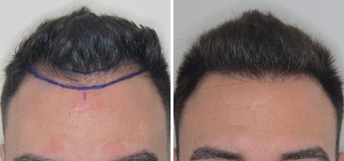 Hair Transplant before and after, frontal.