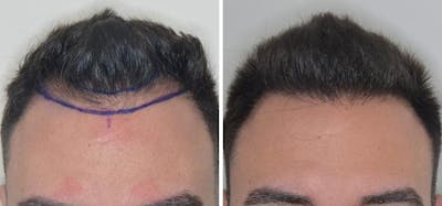 Hair Transplant before and after, frontal.