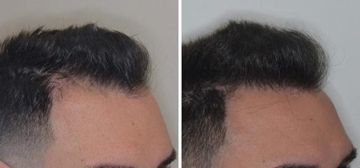 Hair Transplant before and after, oblique right.