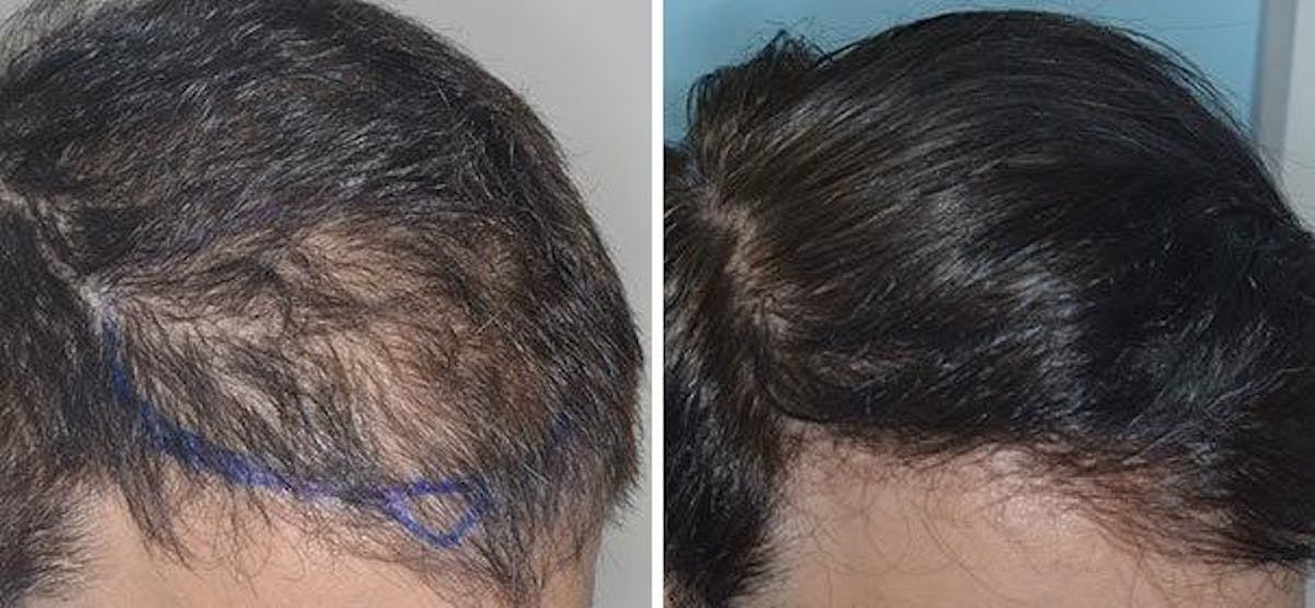 Hair Transplant before and after, oblique right.
