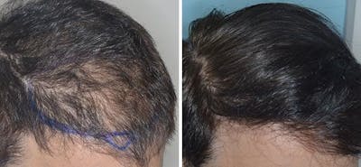 Hair Transplant before and after, oblique right.