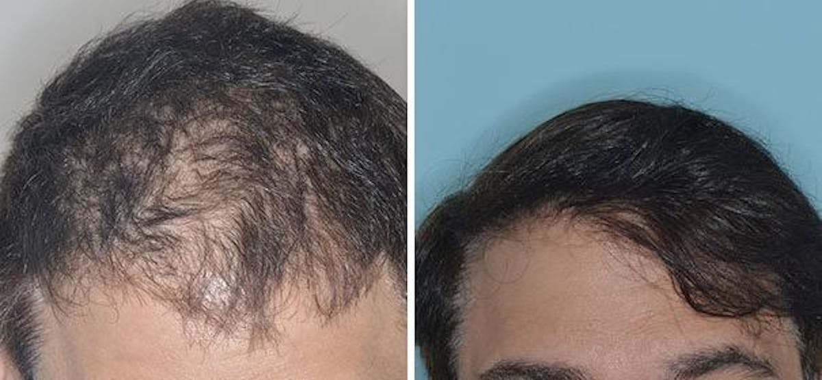 Hair Transplant before and after, frontal.