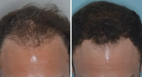 Hair Transplant before and after, frontal.