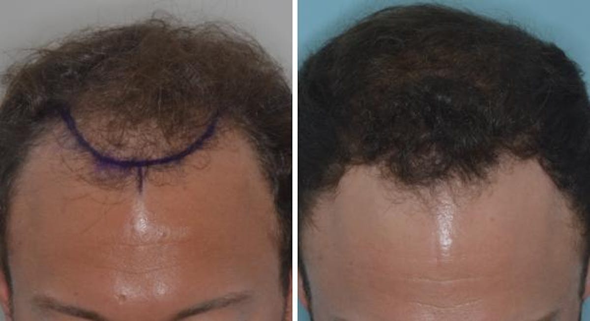 Hair Transplant before and after, marked.