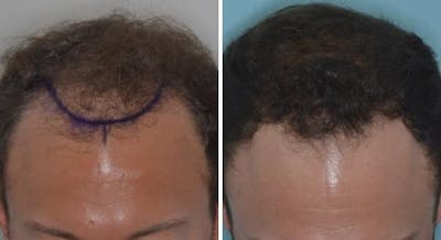 Hair Transplant before and after, marked.