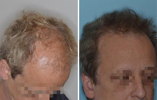 Hair Transplant before and after, oblique right.