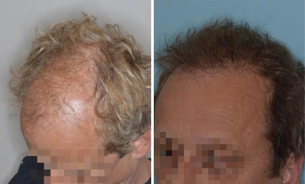 Hair Transplant before and after, oblique left.