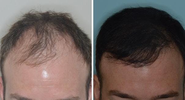 Hair Transplant before and after, frontal.