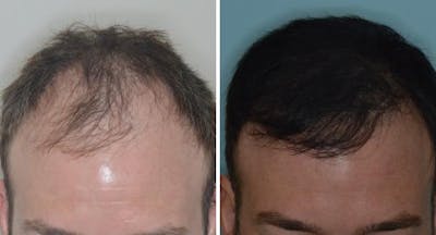Hair Transplant before and after, frontal.