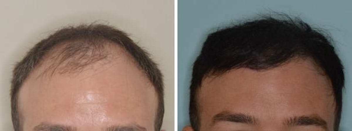 Hair Transplant before and after, frontal.