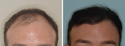 Hair Transplant before and after, frontal.