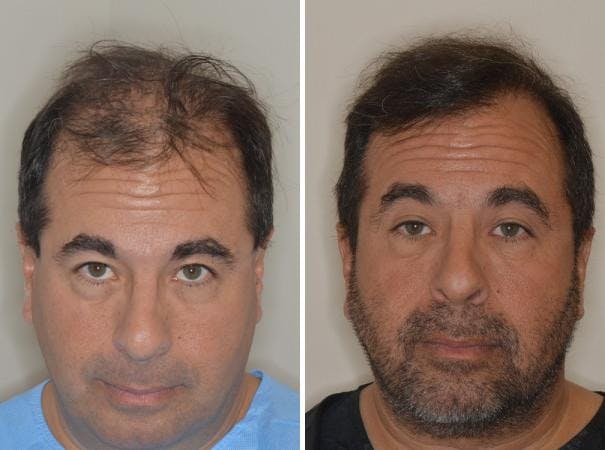 Hair Transplant before and after, frontal.
