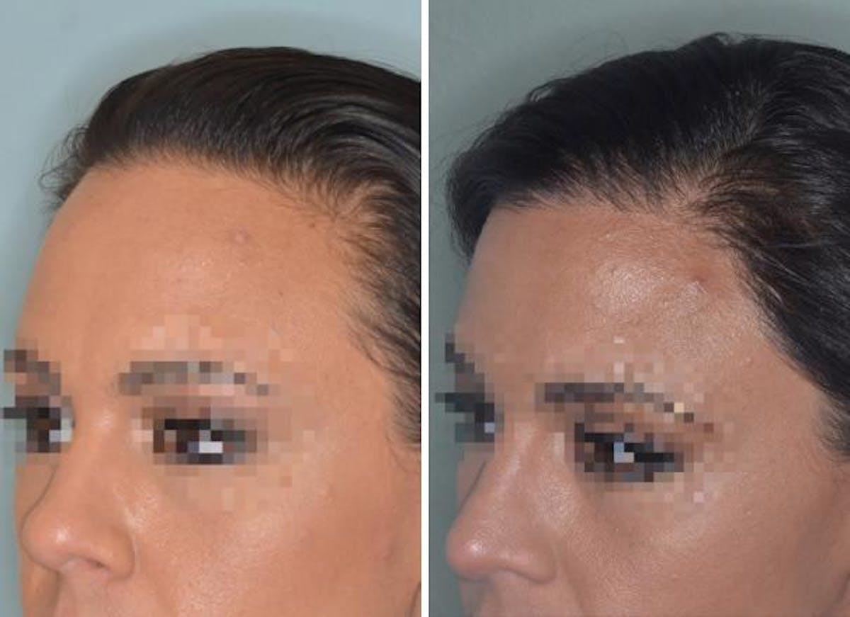 Hair Transplant before and after, oblique left.
