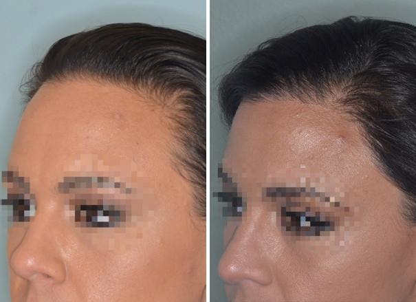 Hair Transplant before and after, oblique left.