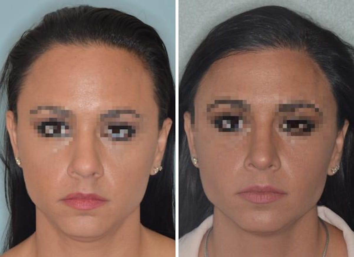 Hair Transplant before and after, frontal.