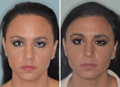Hair Transplant before and after, frontal.