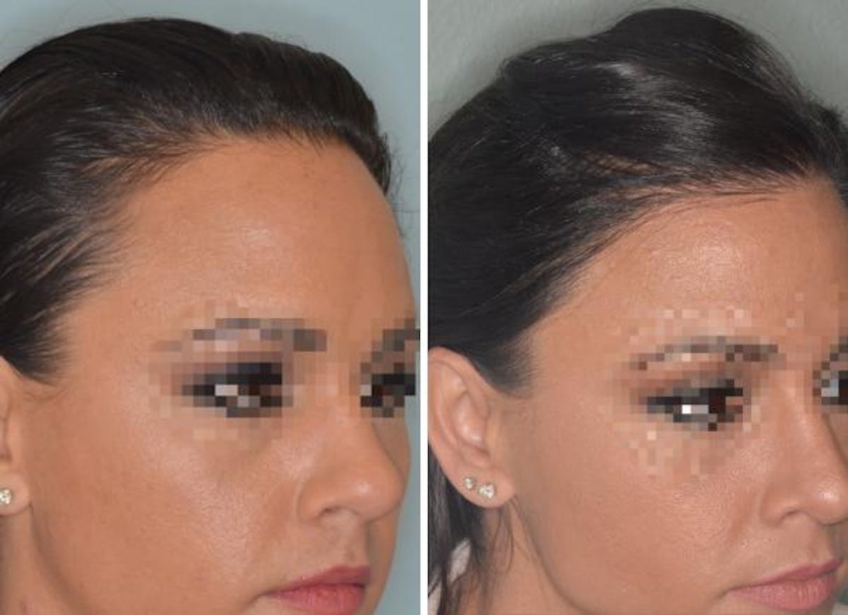 Hair Transplant before and after, oblique right.