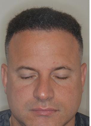 Hair Transplant before and after, frontal.