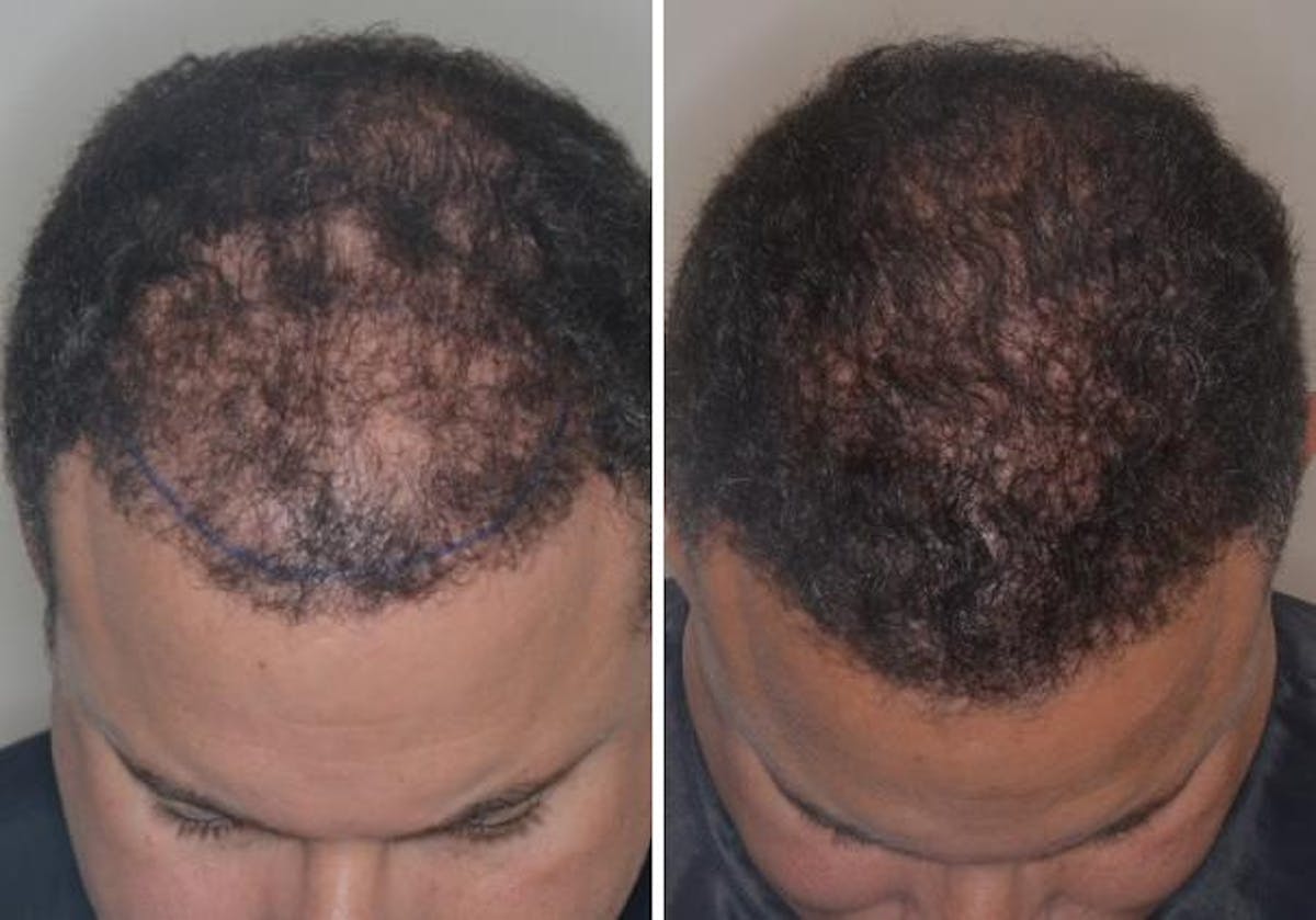 Hair Transplant before and after, frontal.