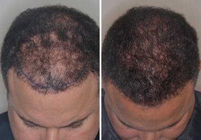 Hair Transplant before and after, frontal.