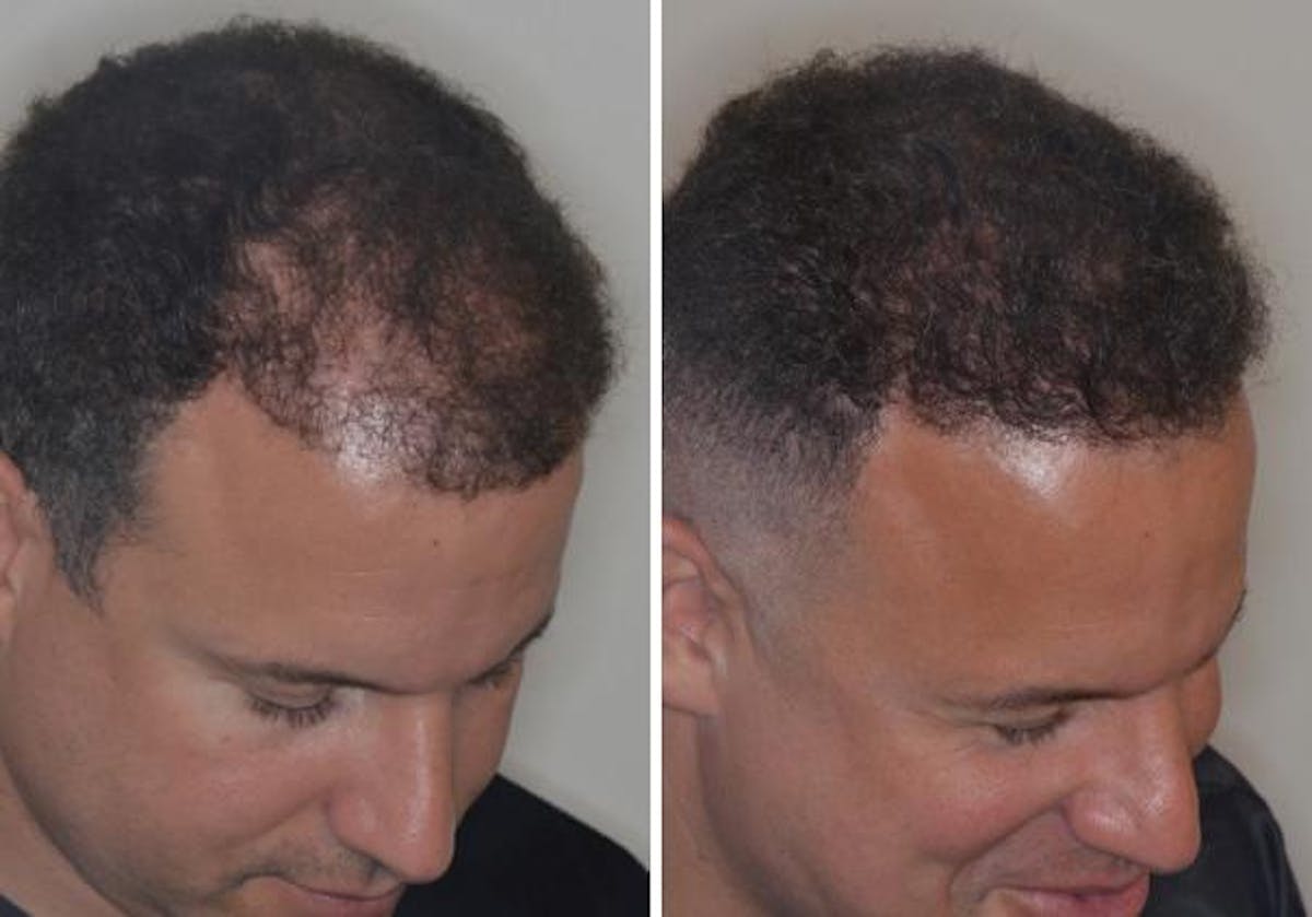 Hair Transplant before and after, oblique right.