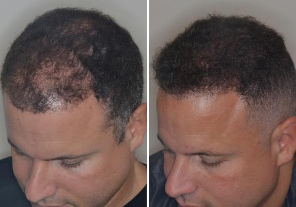 Hair Transplant before and after, oblique left.