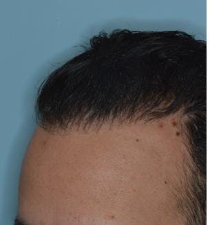 Hair Transplant before and after, oblique left.