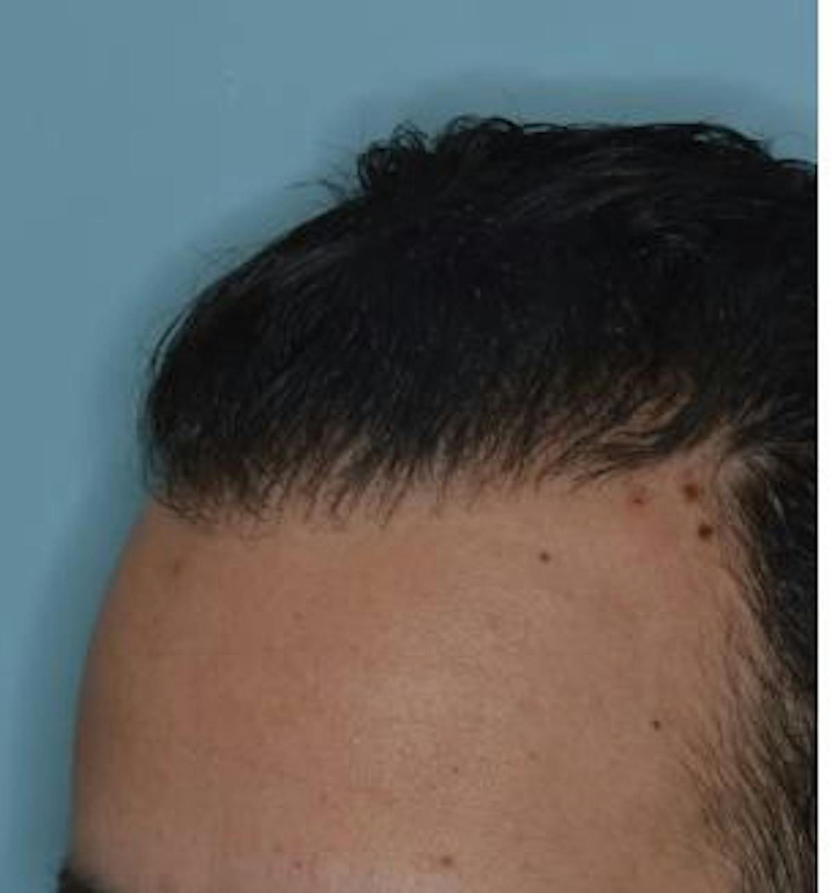 Hair Transplant before and after, oblique left.