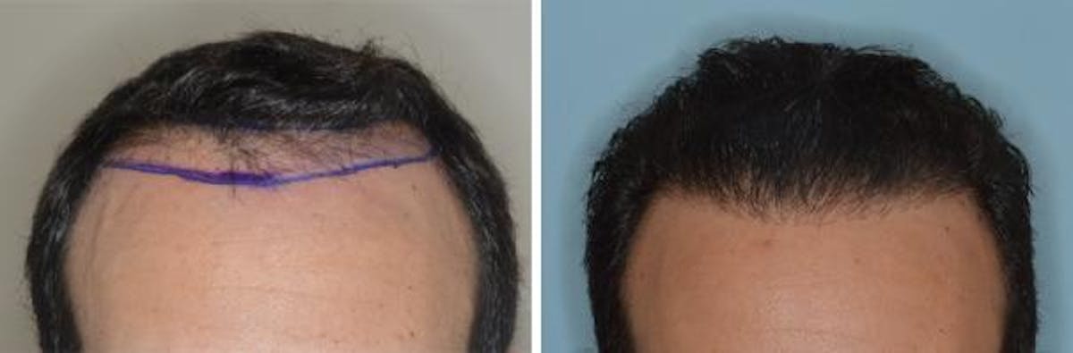 Hair Transplant before and after, marked.