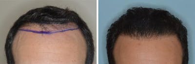 Hair Transplant before and after, marked.