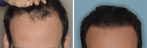 Hair Transplant before and after, frontal.