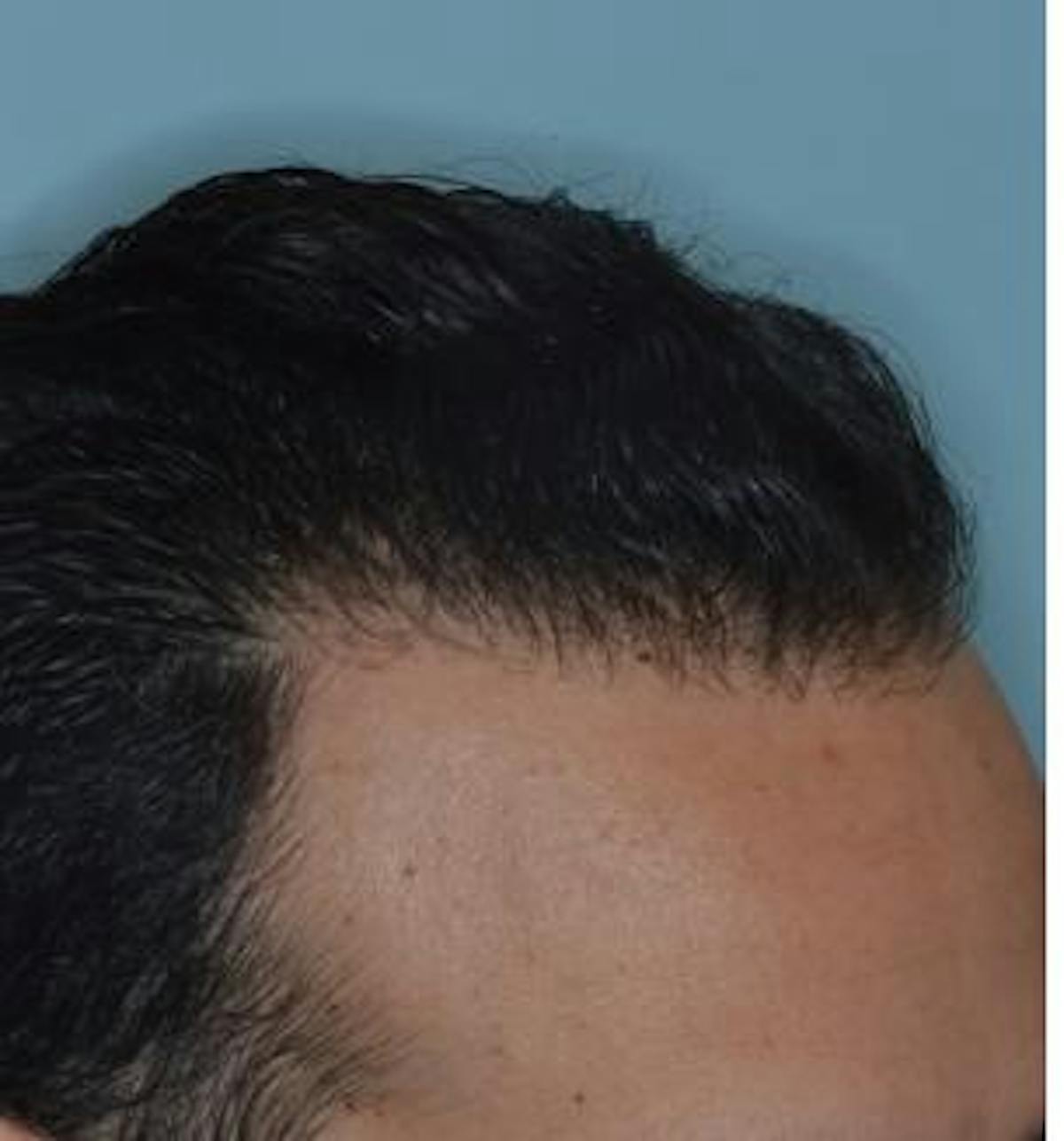 Hair Transplant before and after, lateral right.