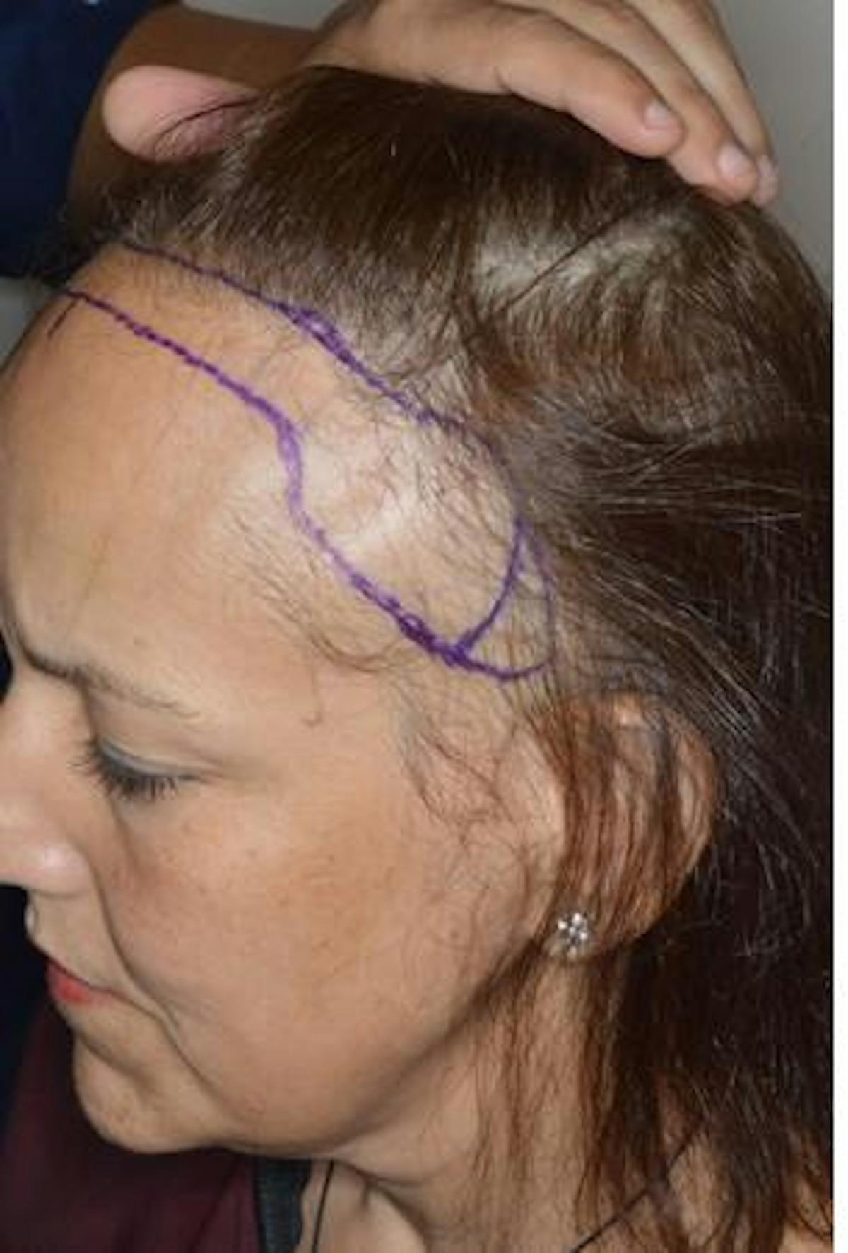 Hair Transplant before and after, marked.