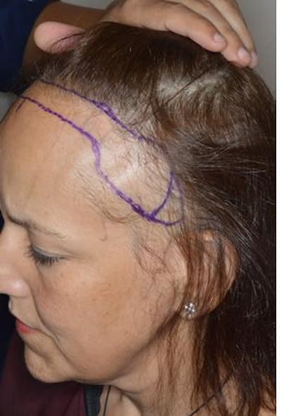 Hair Transplant before and after, marked.