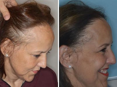 Hair Transplant before and after, oblique right.