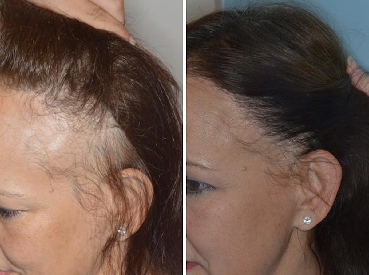 Hair Transplant before and after, oblique left.