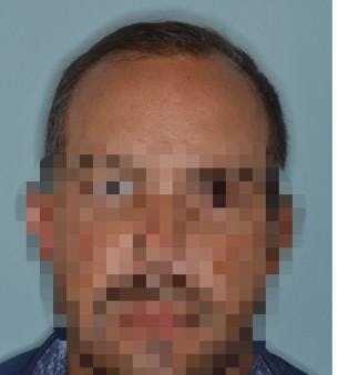 Hair Transplant before and after, frontal.