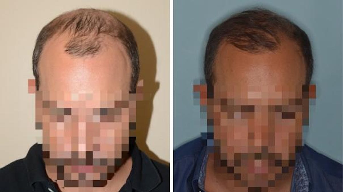 Hair Transplant before and after, frontal.
