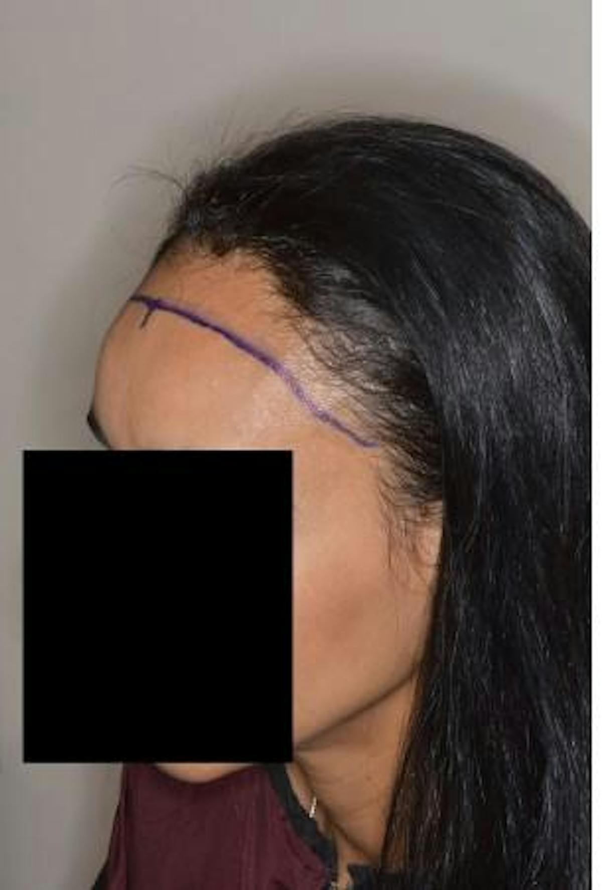 Hair Transplant before and after, marked.