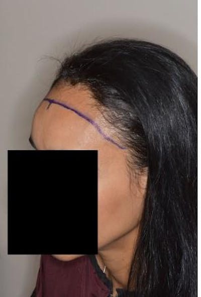 Hair Transplant before and after, marked.