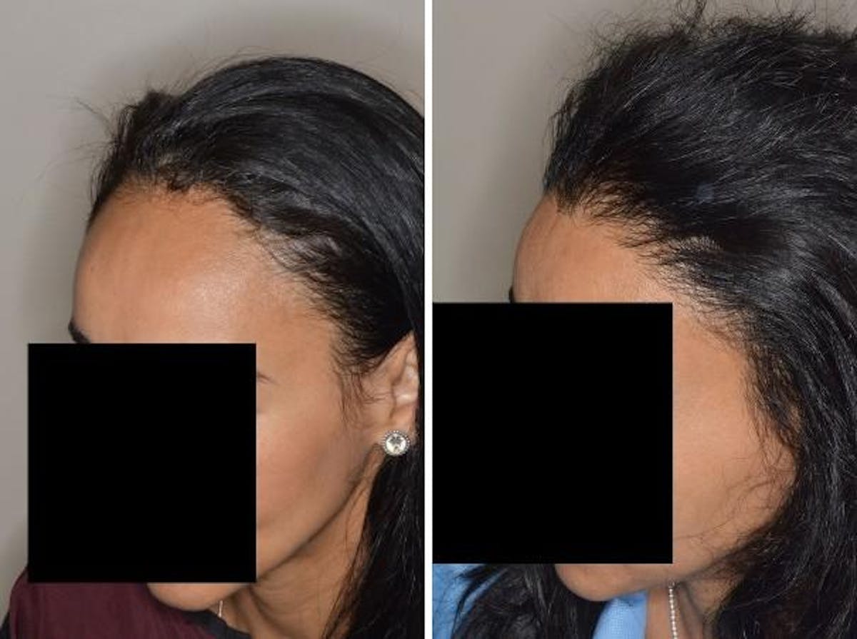 Hair Transplant before and after, oblique left.