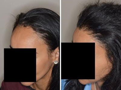 Hair Transplant before and after, oblique left.