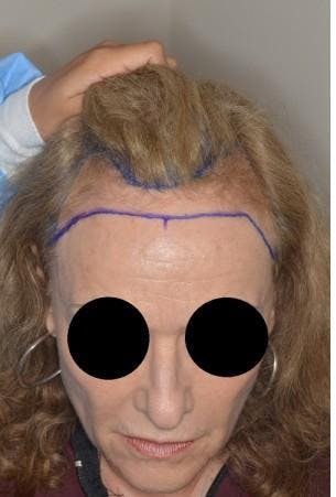 Hair Transplant before and after, marked.