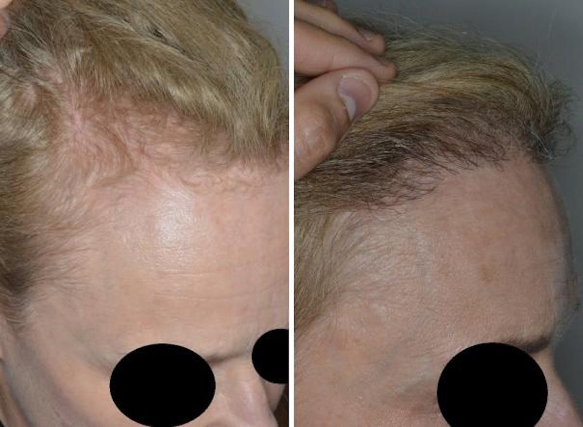 Hair Transplant before and after, oblique right.